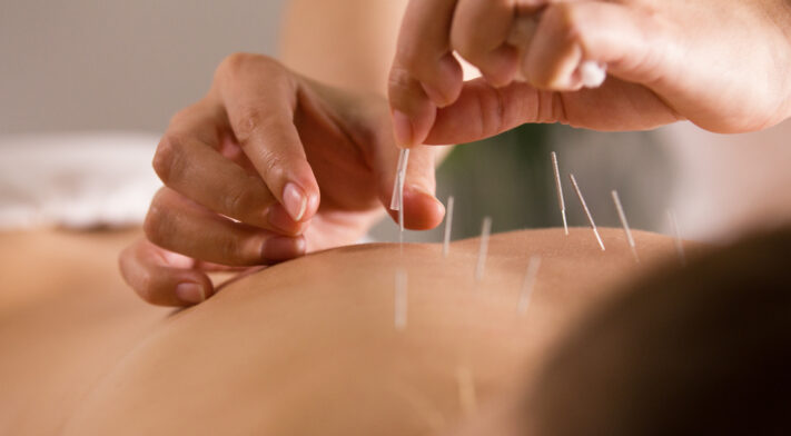 Santé féminine : 6 utilisations de l’acupuncture