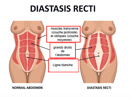 Grossesse : Démystifions la diastase des grands droits de l'abdomen -  Kinatex Saint-Vallier