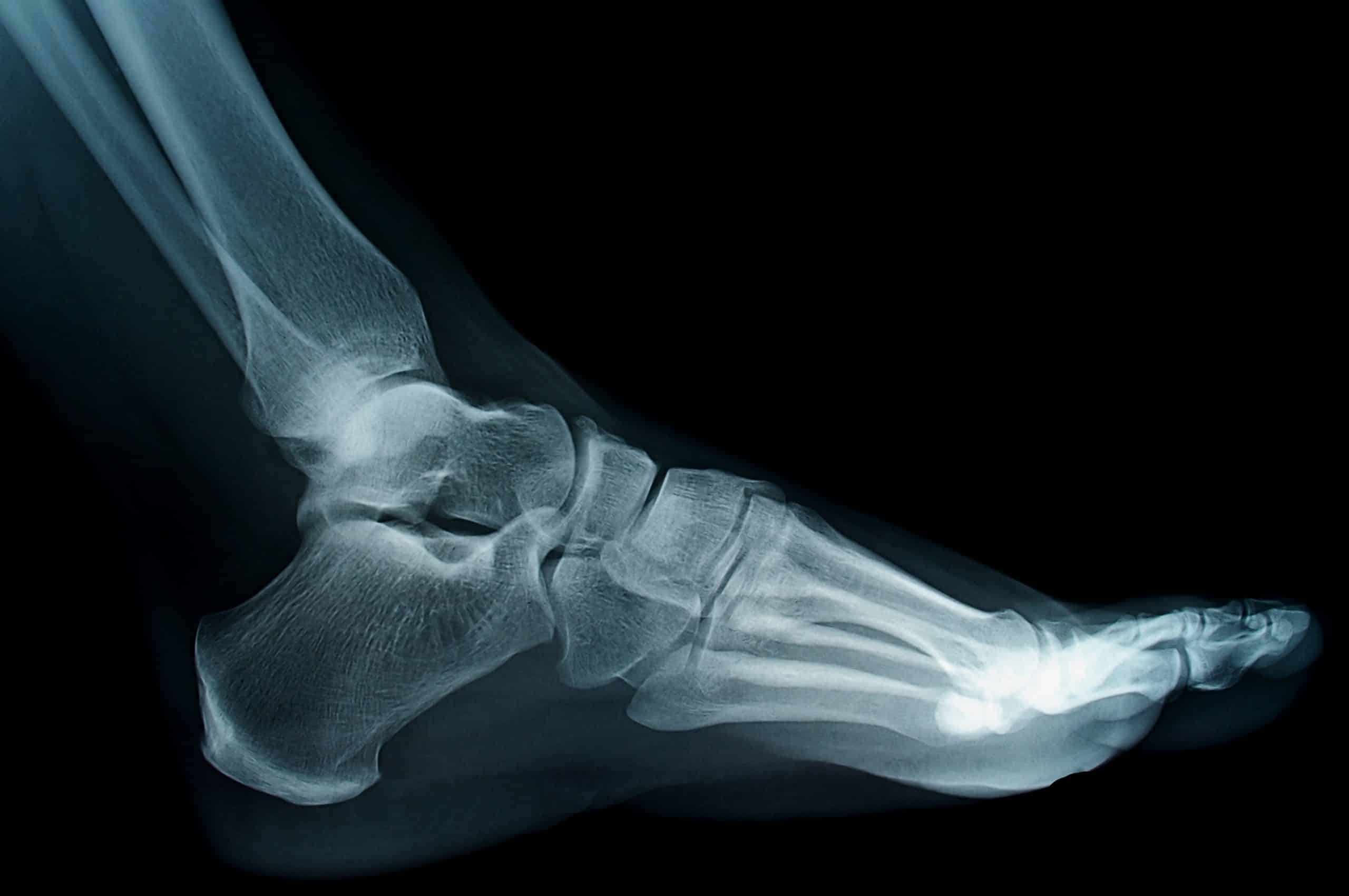Снимок. Рентген порванных связок на ноге.