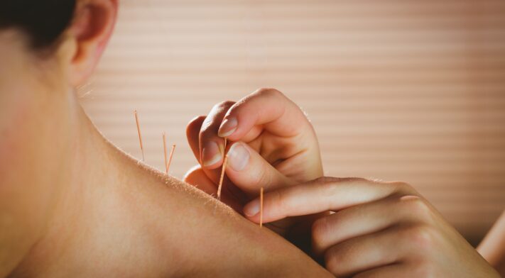 acupuncture-puncture