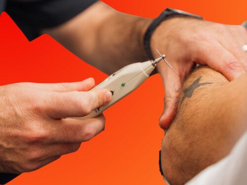 Myofascial Dry Needling