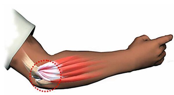 L'épicondylite (Tennis elbow) et ses caractéristiques Le massage thaïlandais à l’huile et la tendinopathie chez Kinatex Sports Physio, Québec et Ontario.
