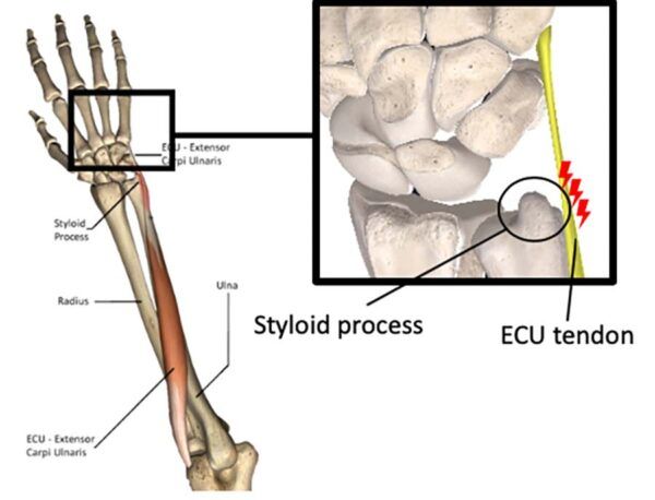Ulnar wrist pain and posture at Kinatex Sports Physio, Quebec and Ontario.