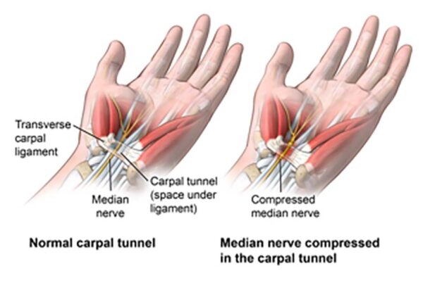 Wrist pain and posture and carpal tunnel at Kinatex Sports Physio, Quebec and Ontario.