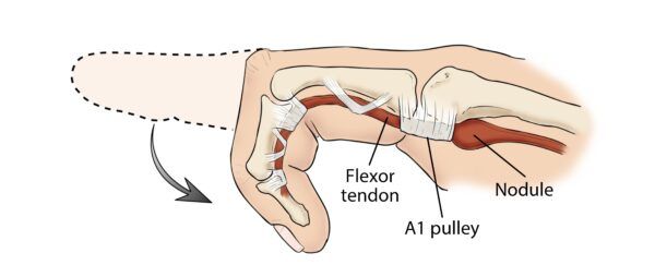 Doigt à ressaut : symptômes, causes et traitements efficaces chez Kinatex Sports Physio, Québec et Ontario.