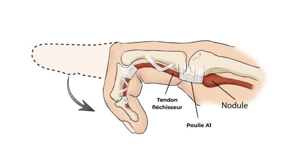 Doigt à ressaut : symptômes, causes et traitements efficaces chez Kinatex Sports Physio, Québec et Ontario.