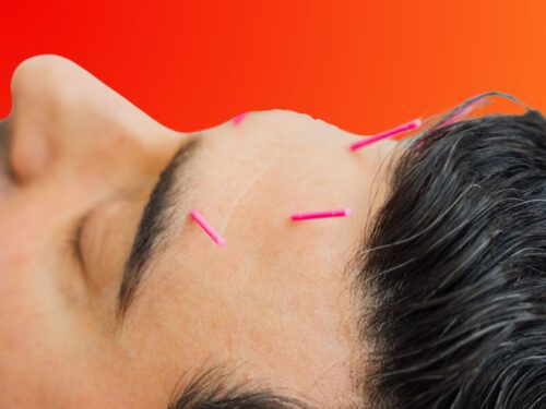 Acupuncture esthétique