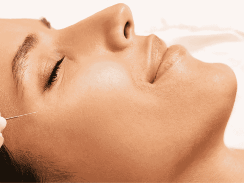 Rajeunissez naturellement grâce à l’acupuncture esthétique chez Kinatex Sports Physio, Québec et Ontario.