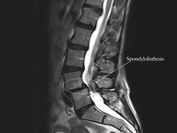 La colonne lombaire à l’épreuve du cirque : Focus sur la spondylolyse et le spondylolisthésis 