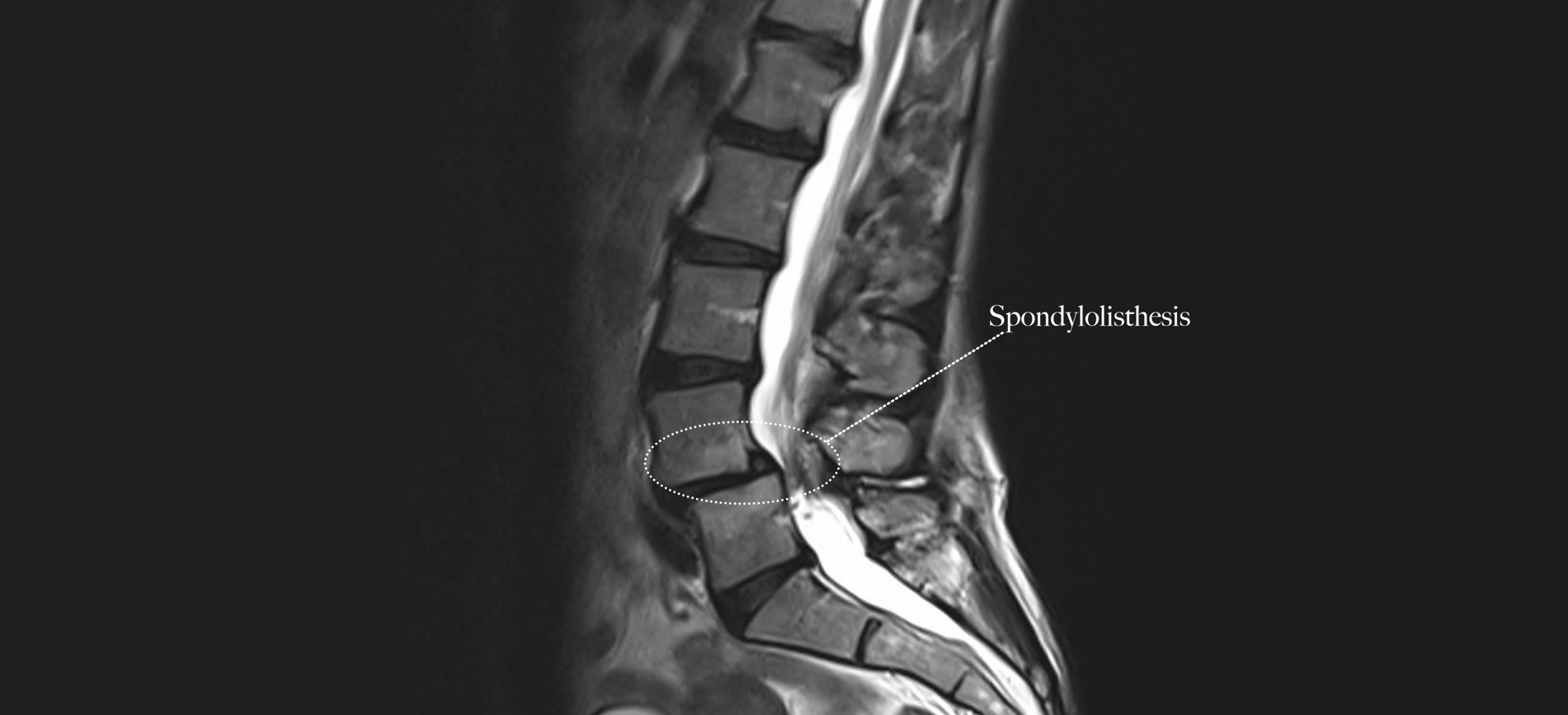 The Lumbar Spine Under the Demands of Circus Arts: Focus on Spondylolysis and Spondylolisthesis